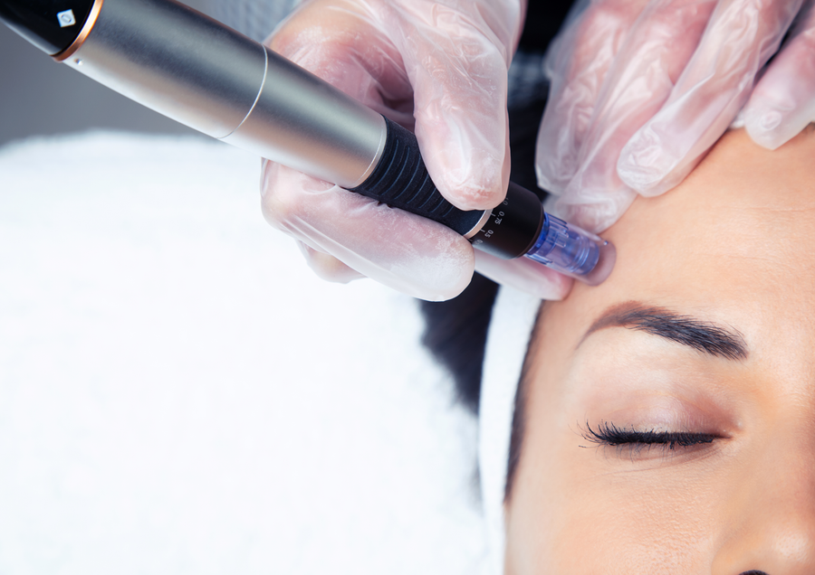Kosmetikerin führt eine professionelle Micro-Needling-Behandlung im Gesicht einer Kundin durch.