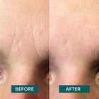 APRICOT Gesicht Patches mit Hyaluron für die Pflege von Stirn und Gesichtspartien