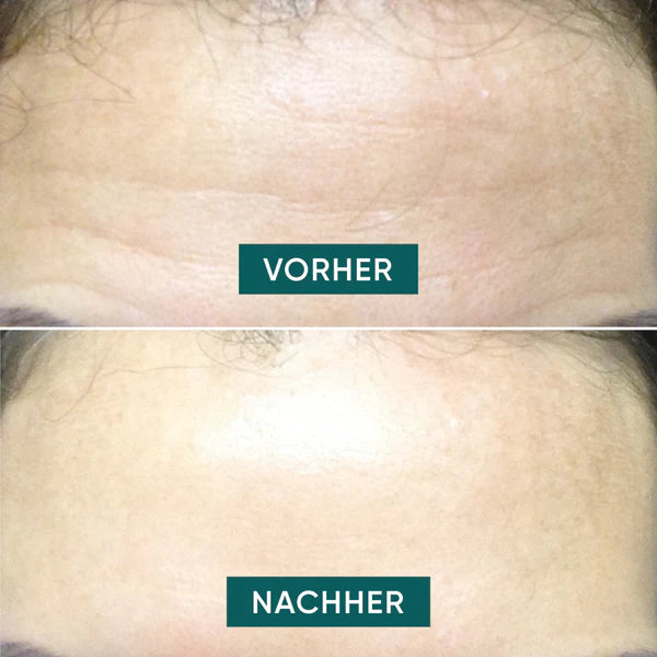 APRICOT Stirn Pad mit Hyaluron für die Pflege und Feuchtigkeitsversorgung der Stirnpartie