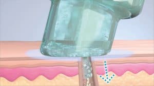 Hydrafacial